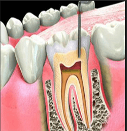 single-sitting-root-canal-treatment